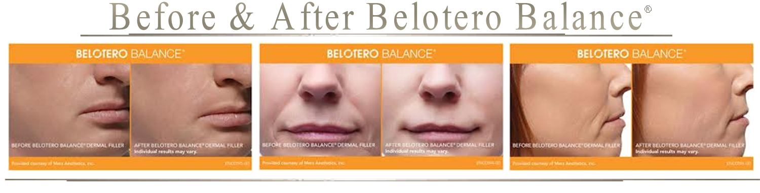 Belotero shape отзывы