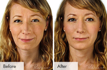 Our Restylane Filler Injections - Refine Facial Plastic Surgery PDFs thumbnail