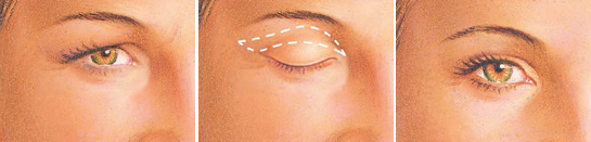 Blepharoplasty